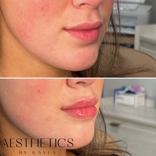 Before and After Image: Lip Filler - right-front-oblique